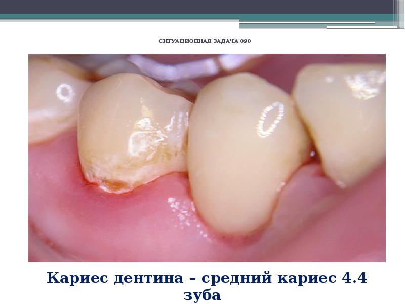 Лечебные прокладки в стоматологии презентация