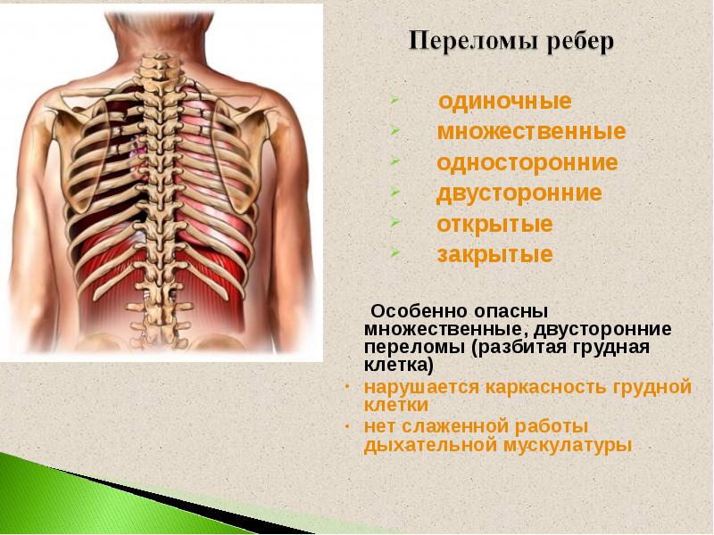 Закрытые травмы грудной клетки презентация