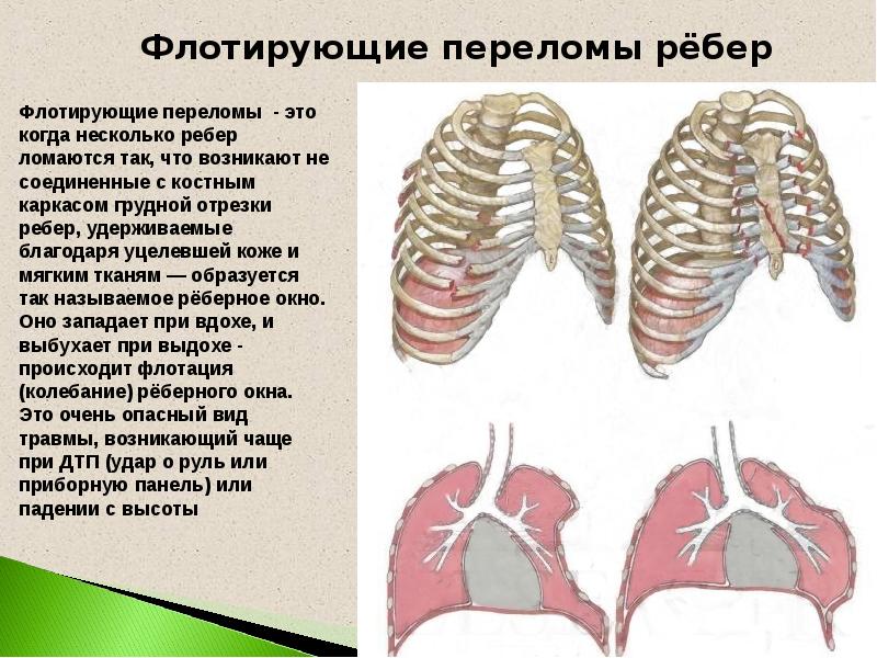 Травма груди презентация