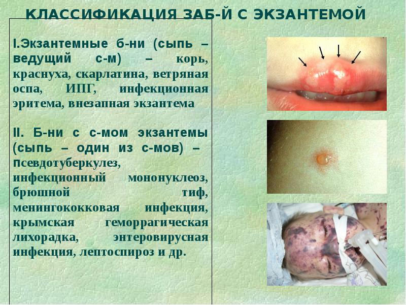 Дифференциальная диагностика сыпи презентация