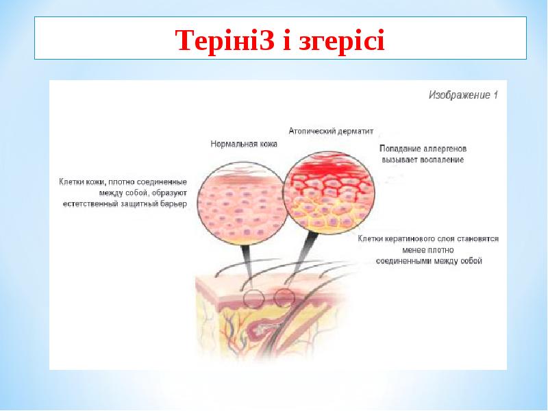 Атопический дерматит схема кожи