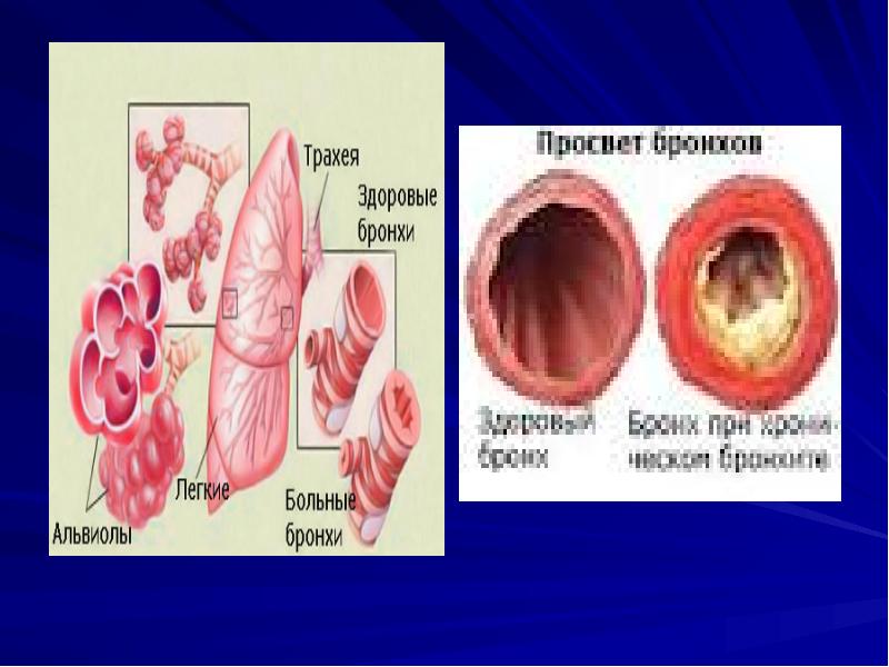 Стенки бронхов уплотнены