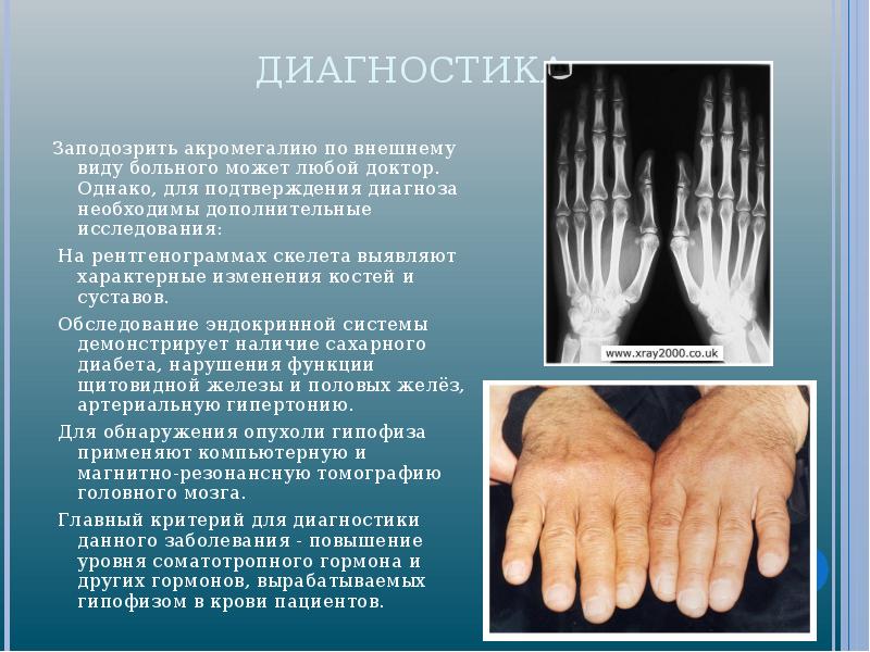 Гигантизм акромегалия презентация