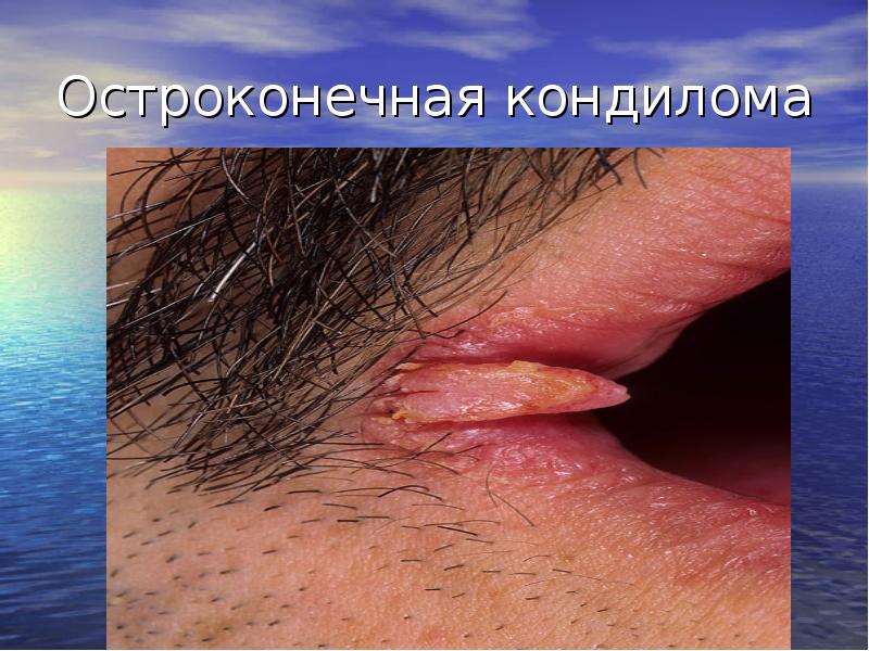 Остроконечная кондилома Остроконечная кондилома