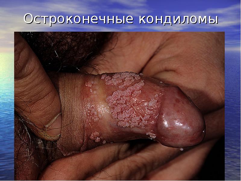 Остроконечные кондиломы Остроконечные кондиломы