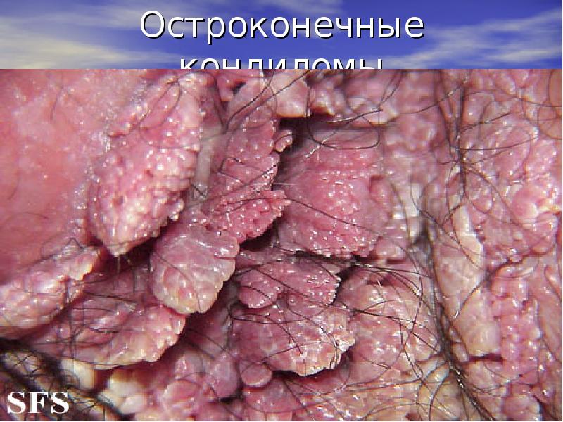 Остроконечные кондиломы Остроконечные кондиломы