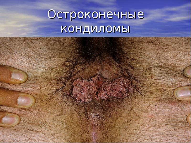 Остроконечные кондиломы Остроконечные кондиломы