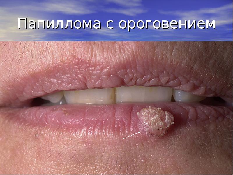 Папиллома с ороговением Папиллома с ороговением