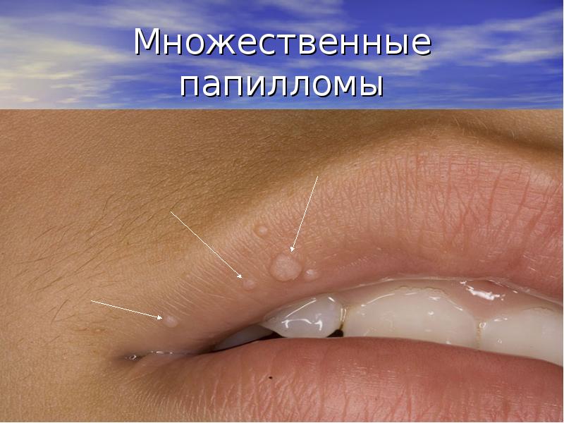 Множественные папилломы Множественные папилломы
