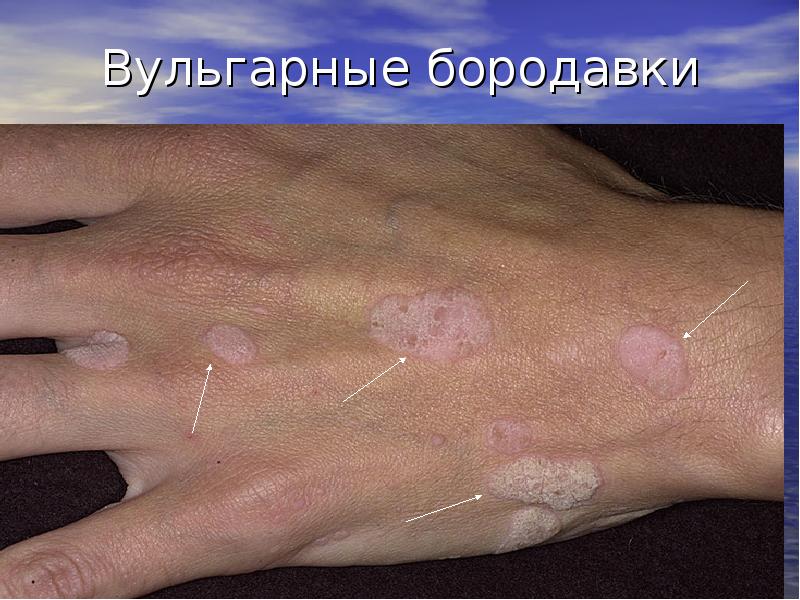 Вульгарные бородавки Вульгарные бородавки