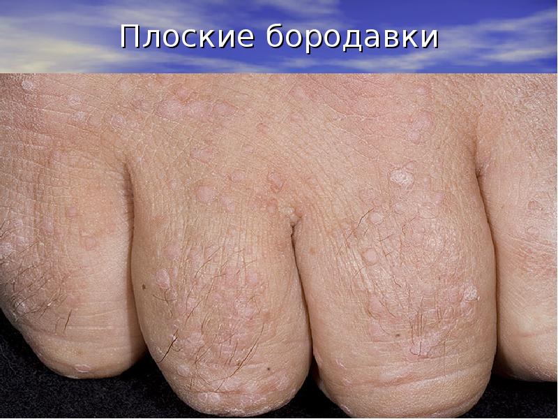 Плоские бородавки Плоские бородавки