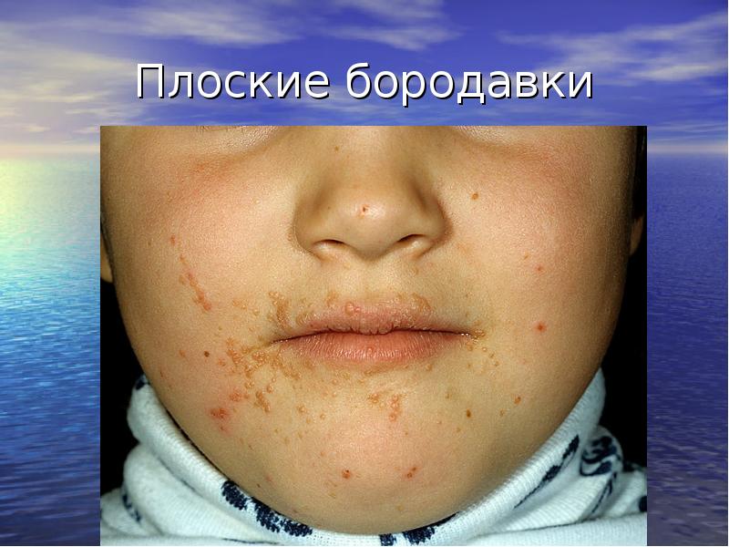 Плоские бородавки Плоские бородавки