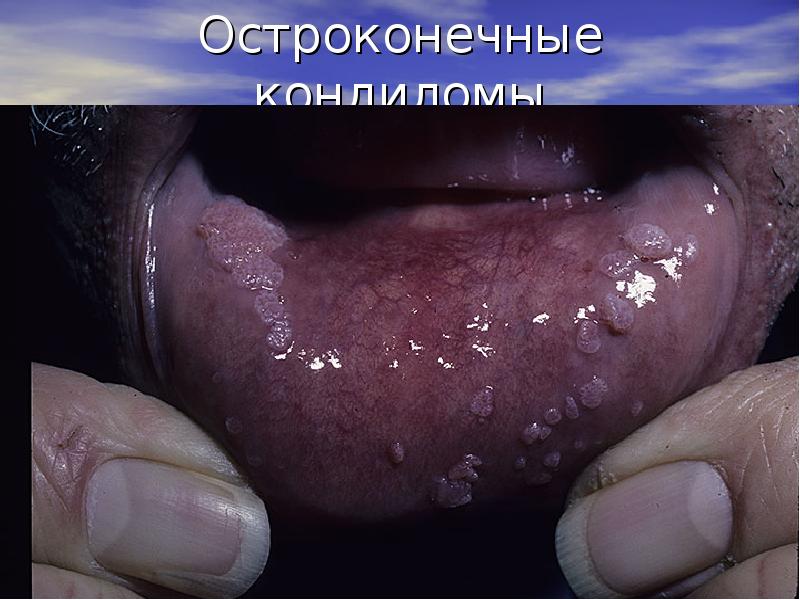 Остроконечные кондиломы Остроконечные кондиломы