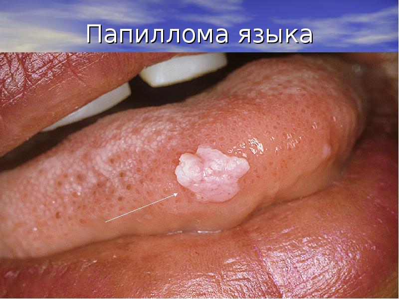 Папиллома языка Папиллома языка
