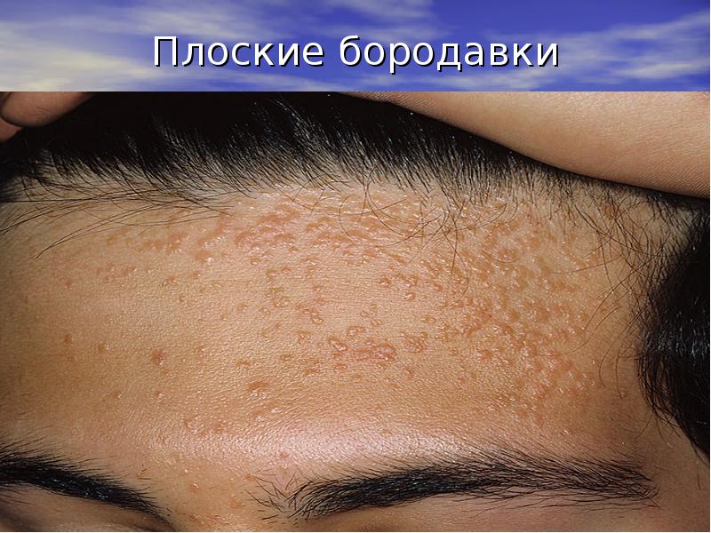 Плоские бородавки Плоские бородавки