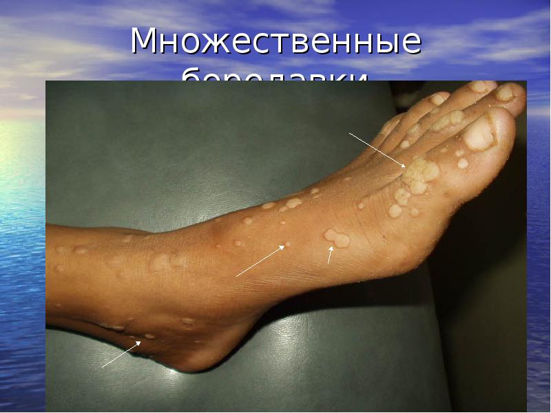 Множественные бородавки Множественные бородавки