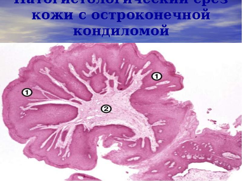 Патогистологический срез кожи с остроконечной кондиломой Патогистологический срез кожи с остроконечной кондиломой