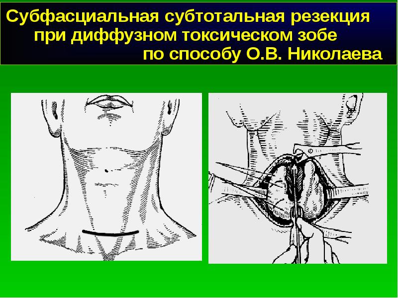 Резекция шеи. Срединные кисты и свищи шеи. Резекция шеи. Субтотальная субфасциальная резекция щитовидной железы. Разрез по кохеру щитовидной железы.