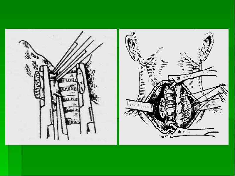 Операции на шее презентация