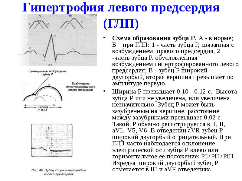 Гипертрофия левого предсердия (ГЛП)
Схема образования зубца Р. А - Гипертрофия левого предсердия (ГЛП)
Схема образования зубца Р. А -