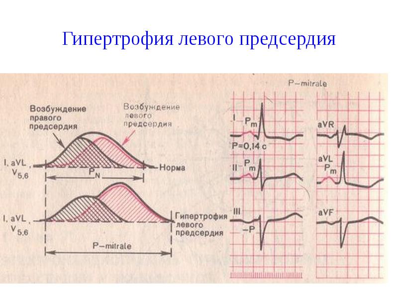 Гипертрофия левого предсердия Гипертрофия левого предсердия