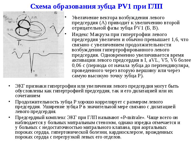 Увеличено левое. Продолжительность зубца p увеличивается при гипертрофии. Индекс Макруза при гипертрофии правого предсердия. ЭКГ при увеличении левого предсердия. Увлечения левого предсердия.