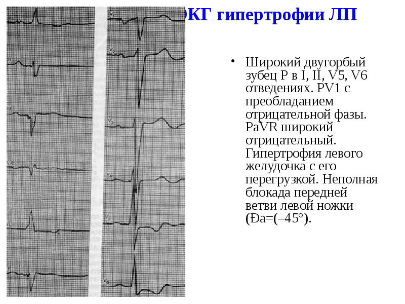 ЭКГ гипертрофии ЛП ЭКГ гипертрофии ЛП