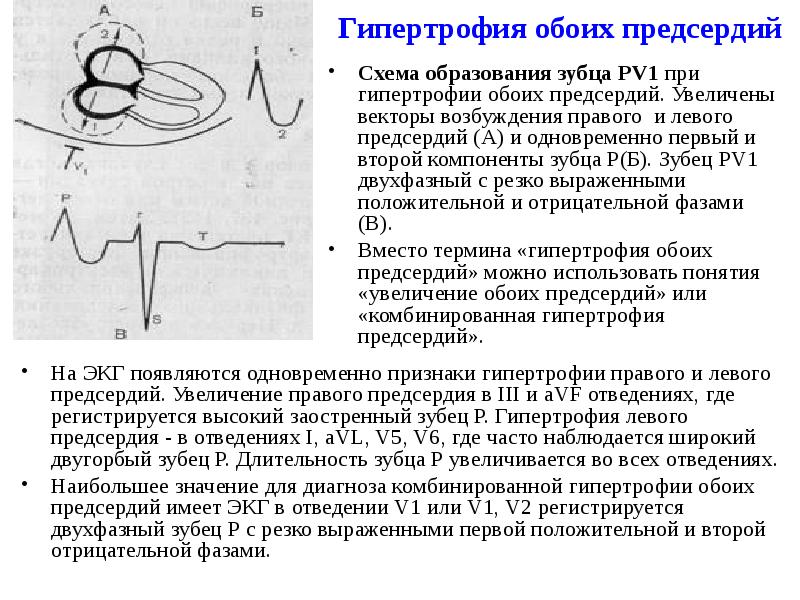 Гипертрофия обоих предсердий
На ЭКГ появляются одновременно признаки гипертрофии правого Гипертрофия обоих предсердий
На ЭКГ появляются одновременно признаки гипертрофии правого