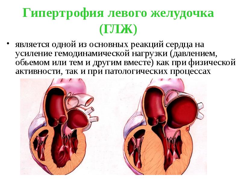 Гипертрофия левого желудочка (ГЛЖ)
является одной из основных реакций сердца на Гипертрофия левого желудочка (ГЛЖ)
является одной из основных реакций сердца на
