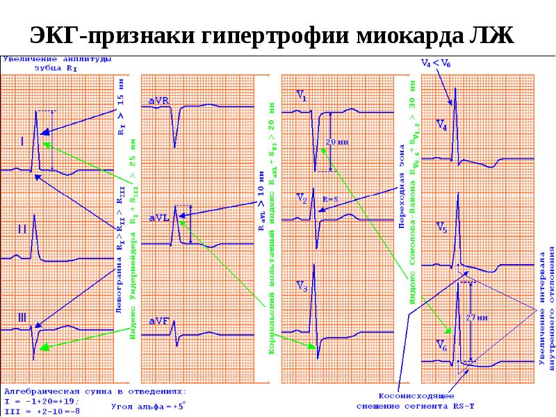 ЭКГ-признаки гипертрофии миокарда ЛЖ ЭКГ-признаки гипертрофии миокарда ЛЖ