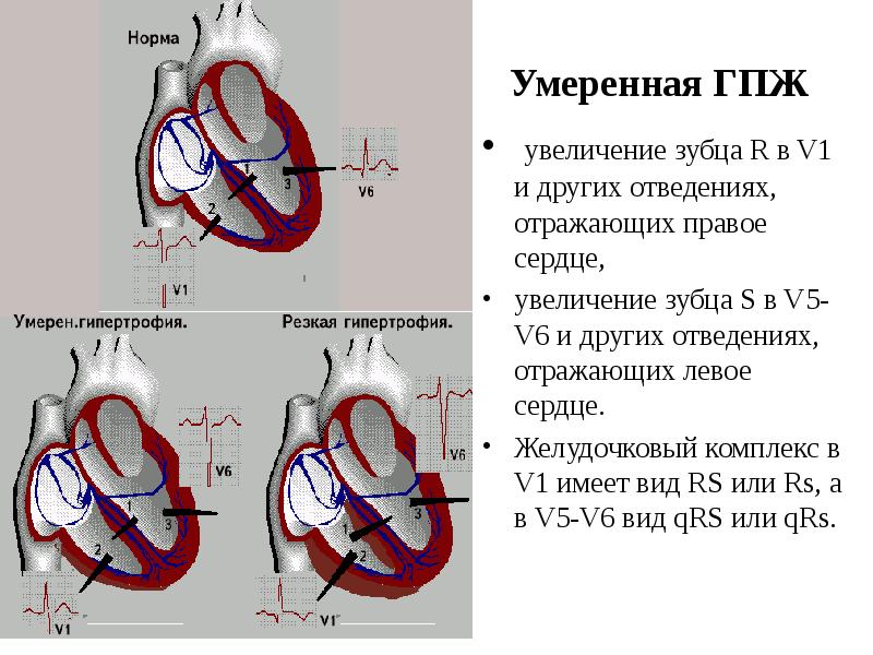 Умеренная ГПЖ
увеличение зубца R в V1 и других отведениях, отражающих Умеренная ГПЖ
увеличение зубца R в V1 и других отведениях, отражающих