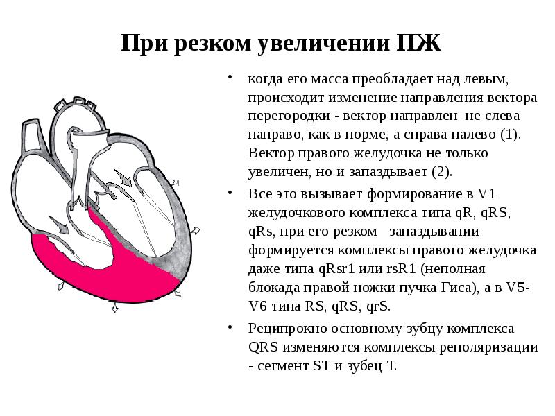 При резком увеличении ПЖ
когда его масса преобладает над левым, происходит При резком увеличении ПЖ
когда его масса преобладает над левым, происходит