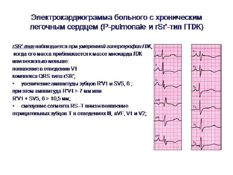 Признаки перегрузки сердца