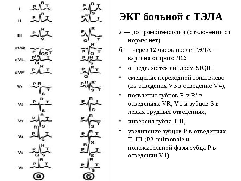 ЭКГ больной с ТЭЛА
а — до тромбоэмболии (отклонений от нормы ЭКГ больной с ТЭЛА
а — до тромбоэмболии (отклонений от нормы