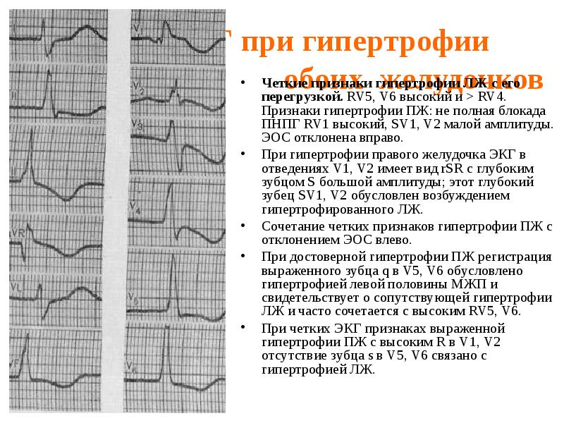 Стенки лж на экг