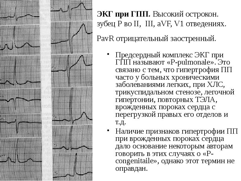 Отрицательный зубец т на экг. Зубец р-pulmonale на ЭКГ. Зубец p на ЭКГ v1. W образный зубец т на ЭКГ. М образный зубец q в отведениях 3,AVF v1-v3.