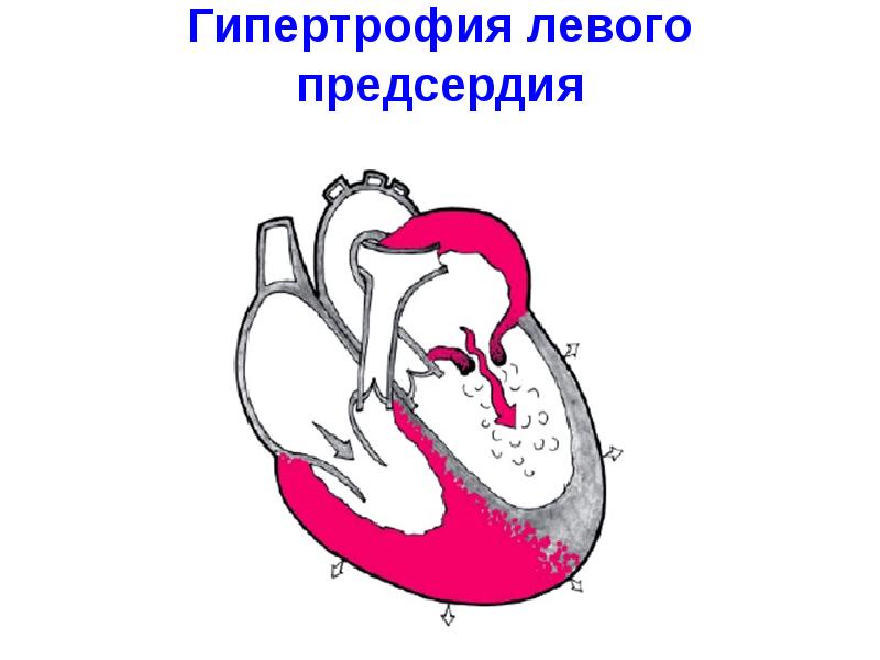 Гипертрофия левого предсердия Гипертрофия левого предсердия
