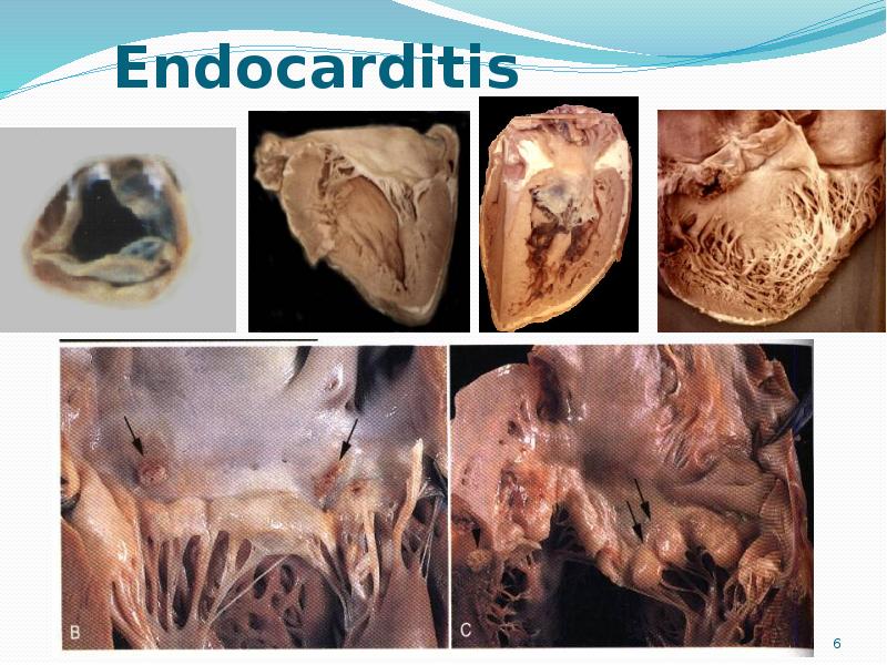 Endocarditis Endocarditis
