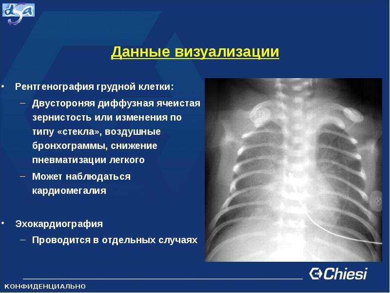 Пневматизация