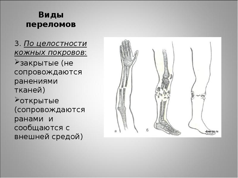 Оказание первой помощи при переломах презентация