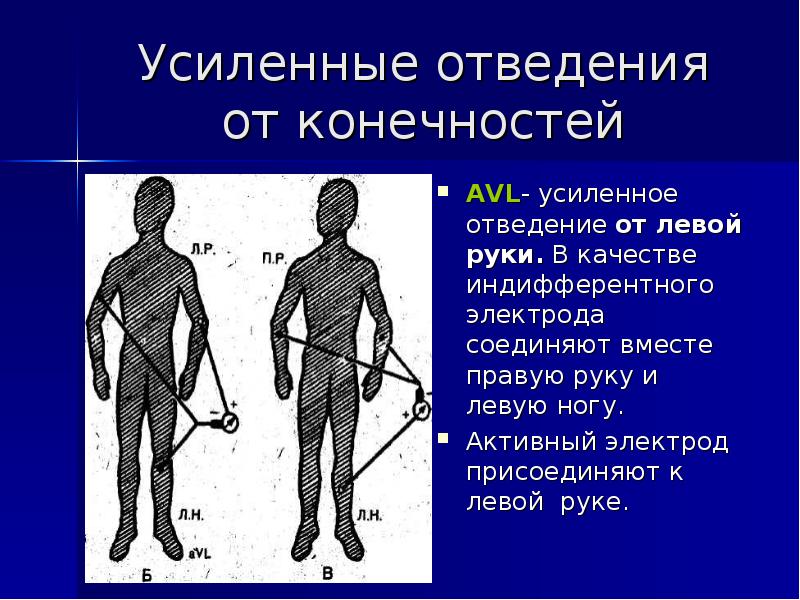 Правые отведения. Отведения от конечностей ЭКГ. Усиленные однополюсные отведения от конечностей. Усиленные отведения от конечностей ЭКГ. Усиленное однополюсное отведение от левой руки.