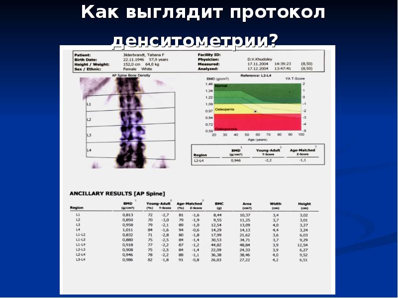 Плотность костей норма