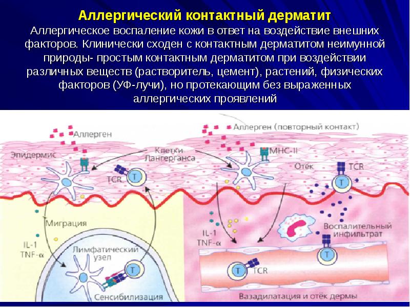 Аллергический контактный дерматит презентация