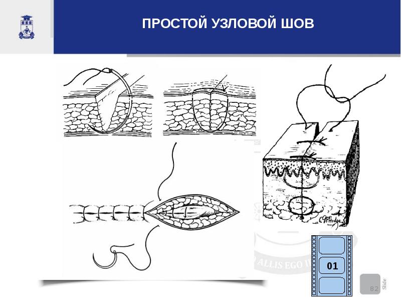 Хирургические швы. Наложение простого узлового шва. Узловой хирургический шов.