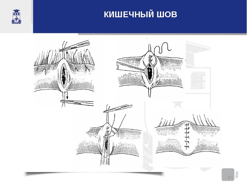 Кишечный шов. Кишечные швы топографическая анатомия. Кишечные швы схема.