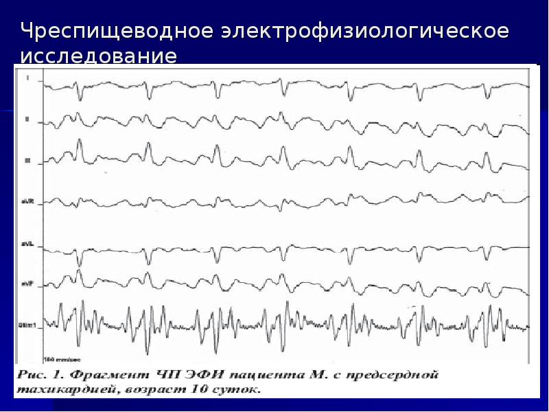 Электрофизиологическое исследование сердца презентация