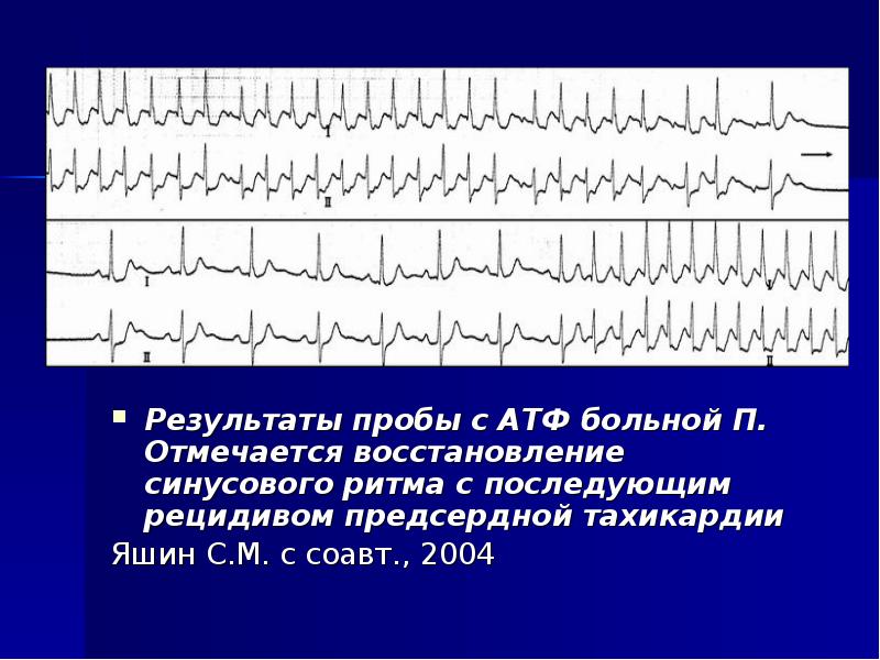 Аритмии у детей презентация