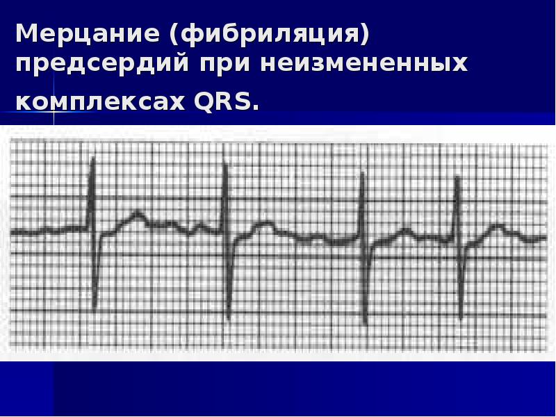 Аритмии презентация факультетская терапия