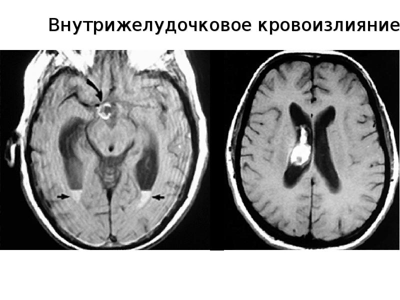 Лечение геморрагического инсульта презентация