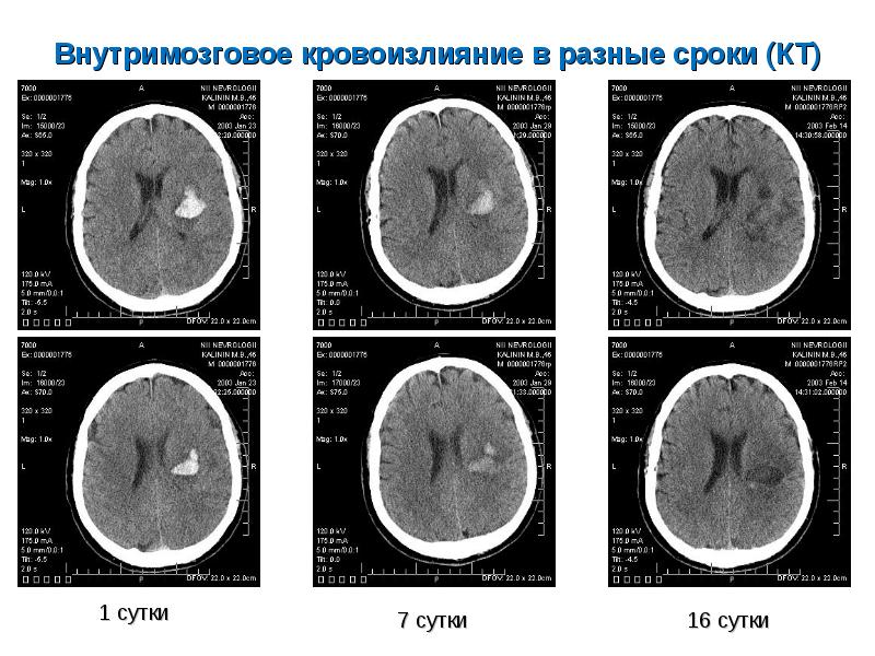 Лечение геморрагического инсульта презентация